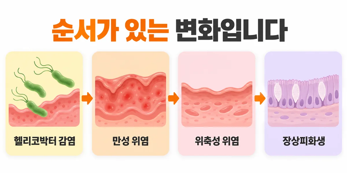 헬리코박터 감염에서 만성 위염, 위축성 위염, 장상피화생으로 이어지는 네 단계 흐름도